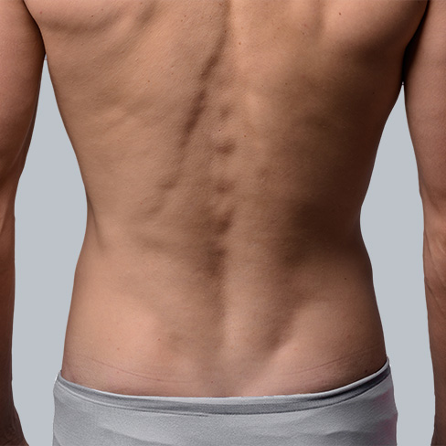 Depilação a Laser ou IPL Lombar Masculino Pacote de 10 Sessões